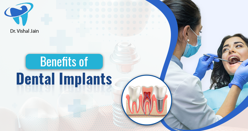 Benefits of Dental Implants, A Comprehensive Guide to Benefits of Dental Implants