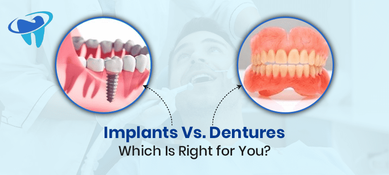 Implants vs Dentures, Implants Vs Dentures: Which Is Right for You?